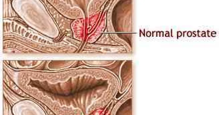 comprendre-le-cancer-de-la-prostate-ce-quil-faut-savoir-sur-un-organe-discret-mais-essentiel