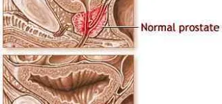 comprendre-le-cancer-de-la-prostate-ce-quil-faut-savoir-sur-un-organe-discret-mais-essentiel