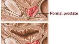 comprendre le cancer de la prostate ce quil faut savoir sur un organe discret mais essentiel