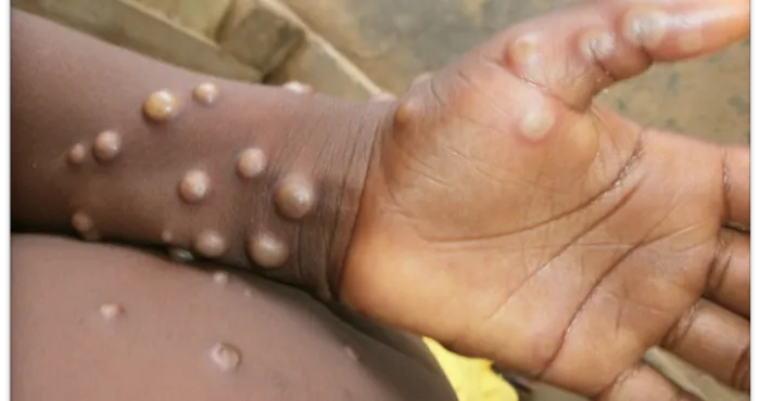 guinee-lepidemie-mpox-fait-de-nouvelles-victimes