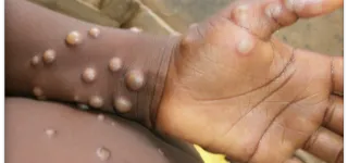 guinee-lepidemie-mpox-fait-de-nouvelles-victimes