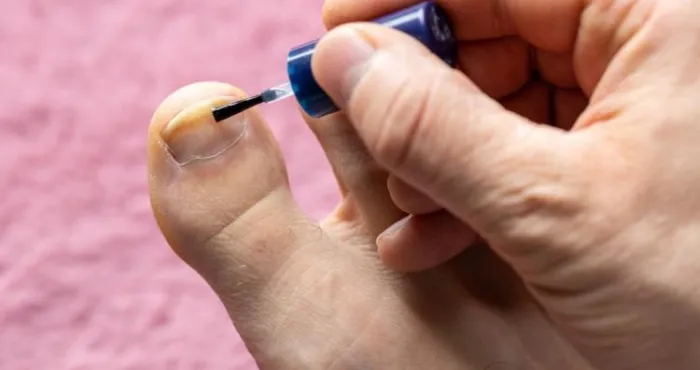 ongles-jaunes-ce-que-la-couleur-revele-sur-votre-sante