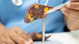 cancer du foie le nombre de cas pourrait doubler dici a 2050