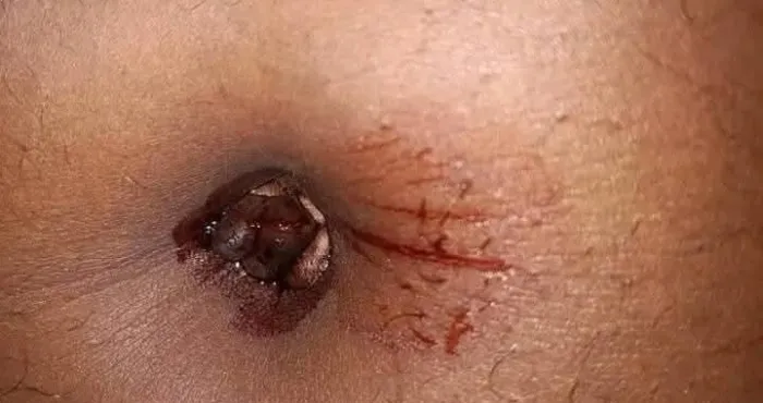 endometriose-ombilicale-le-mal-quon-ne-voit-pas-venir