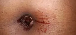 endometriose-ombilicale-le-mal-quon-ne-voit-pas-venir