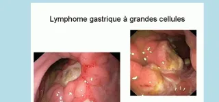 cancer-de-lestomac-comment-eviter-la-maladie