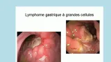 cancer de lestomac comment eviter la maladie