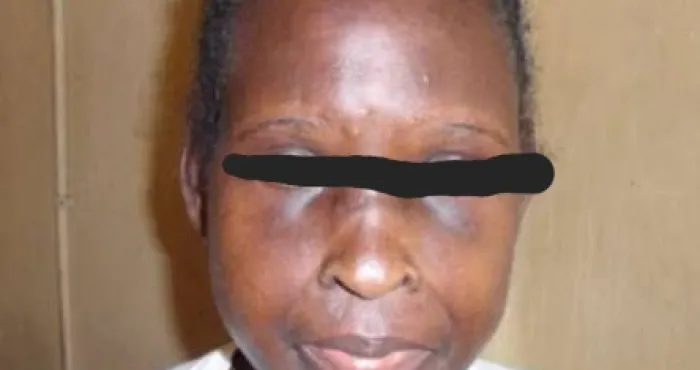 lutte-contre-le-lupus-des-victimes-brisent-le-silence