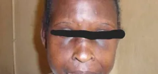 lutte-contre-le-lupus-des-victimes-brisent-le-silence