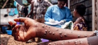 variole-du-singe-lepidemie-gagne-du-terrain-dans-locean-indien