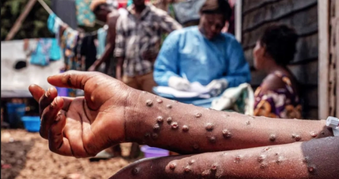variole-du-singe-lepidemie-gagne-du-terrain-dans-locean-indien