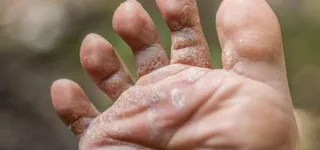 allo-dr-pied-dathlete-comment-prevenir-et-guerir-dun-mal-genant