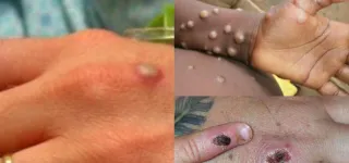 variole-du-singe-au-ghana-la-cote-divoire-hors-de-danger