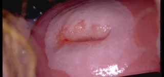 dossier-sante-cancer-du-col-de-luterus-la-mort-au-bout-du-sexe