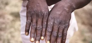 variole-du-singe-lafrique-declare-lurgence-de-sante-publique