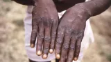variole du singe lafrique declare lurgence de sante publique