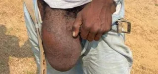 interview-comment-eviter-lhernie-inguinale-dr-koffi-michel-chirurgien-il-faut-limiter-le-port-des-charges-lourdes-en-se-concentrant-le-ventre